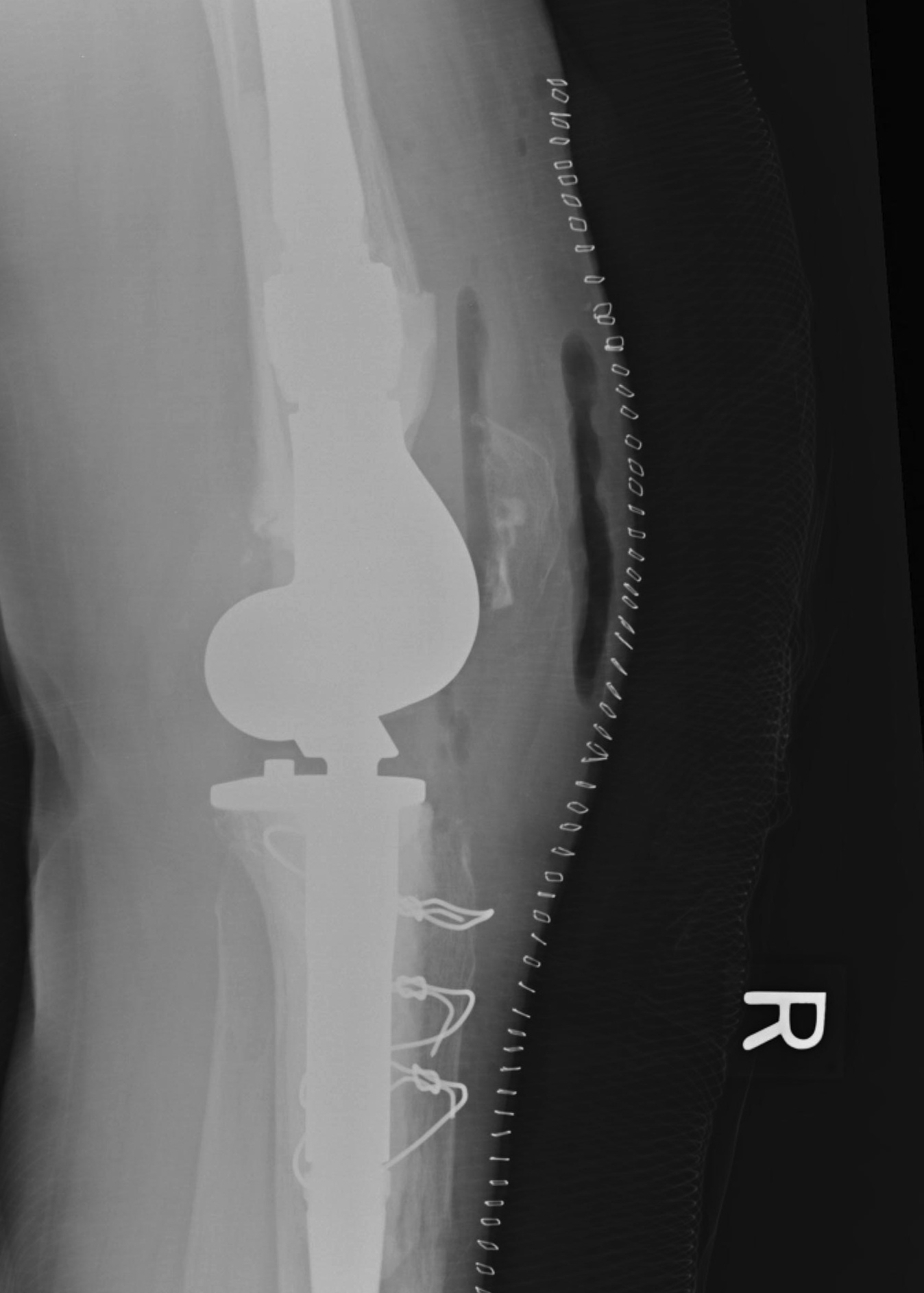 Revision TKR Tumour Implant